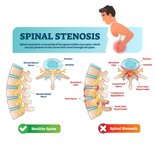 Treating Spinal Stenosis with Expert Eden Prairie Chiropractic Care
